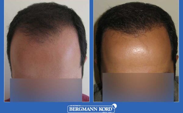 hair-transplantation-bergmann-kord-results-men-60200PG-before-after-001