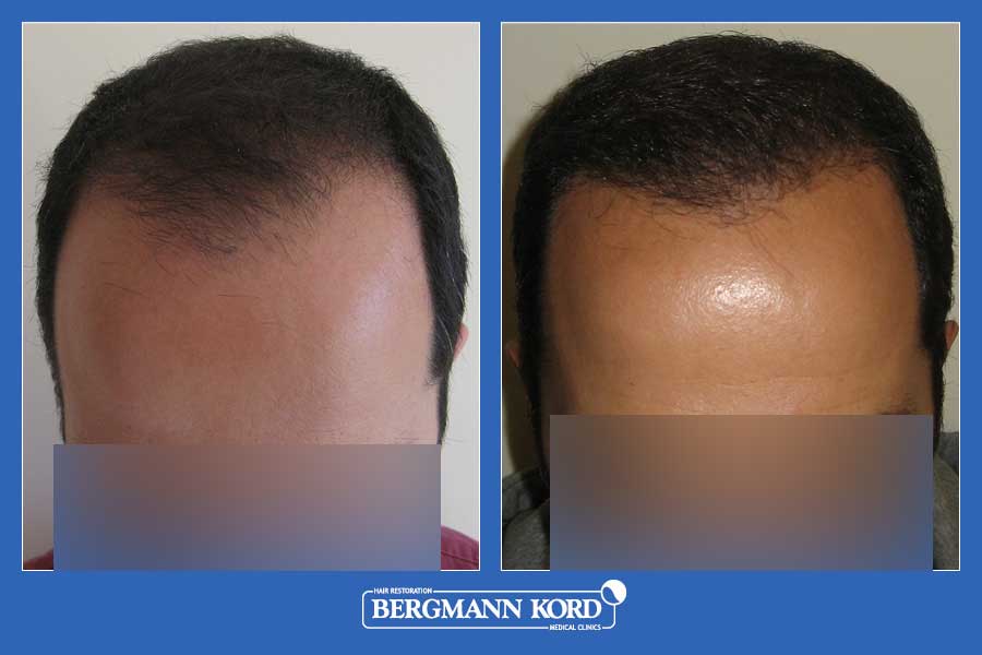hair-transplantation-bergmann-kord-results-men-60200PG-before-after-001
