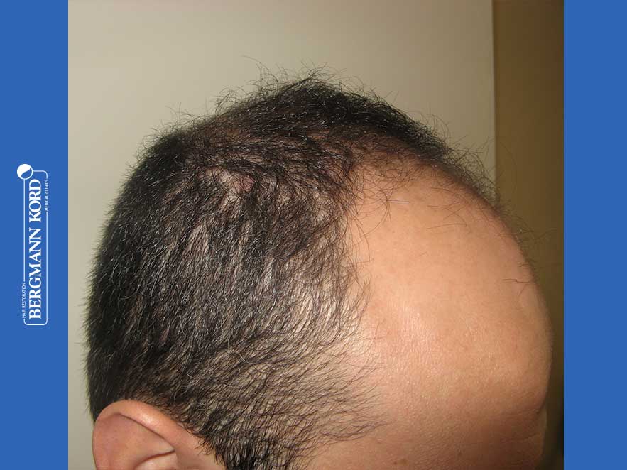 hair-transplantation-bergmann-kord-results-men-66018-before-right-001
