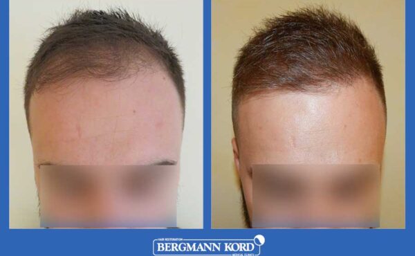 hair-transplantation-bergmann-kord-results-men-69077PG-before-after-001