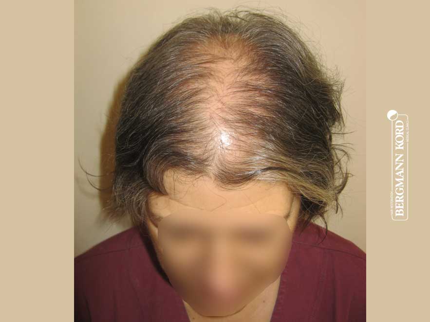 hair-transplantation-bergmann-kord-results-woman-46013PG-before-top-001