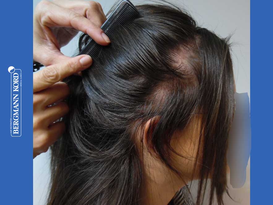 hair-transplantation-bergmann-kord-results-woman-64019PG-after-right-001