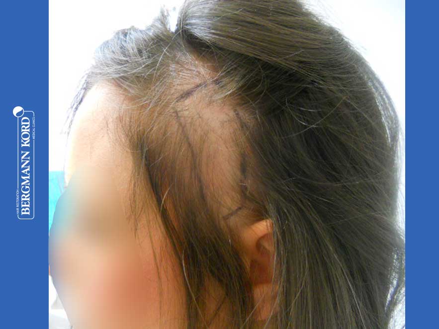 hair-transplantation-bergmann-kord-results-woman-64019PG-before-left-001