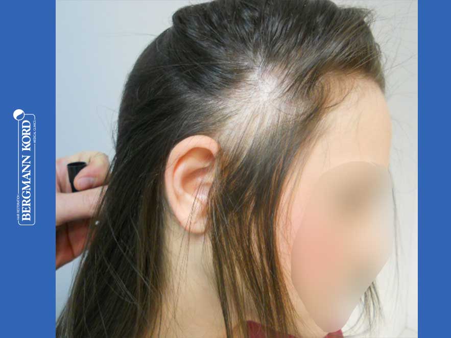 hair-transplantation-bergmann-kord-results-woman-64019PG-before-right-001