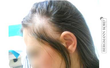 hair-transplantation-bergmann-kord-results-woman-64019PG-thumb-001