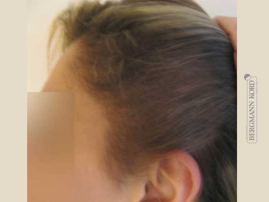 hair-transplantation-bergmann-kord-results-woman-64026PG-after-left-001