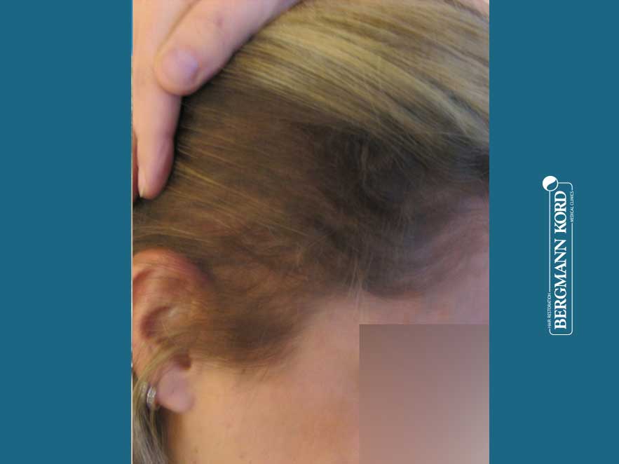 hair-transplantation-bergmann-kord-results-woman-64026PG-after-right-001