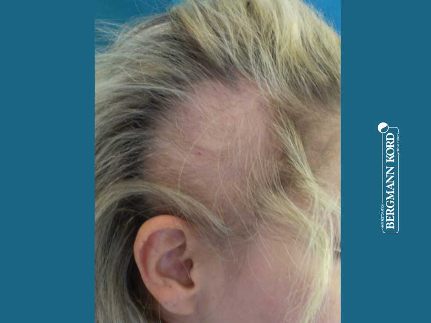 hair-transplantation-bergmann-kord-results-woman-64026PG-before-right-001