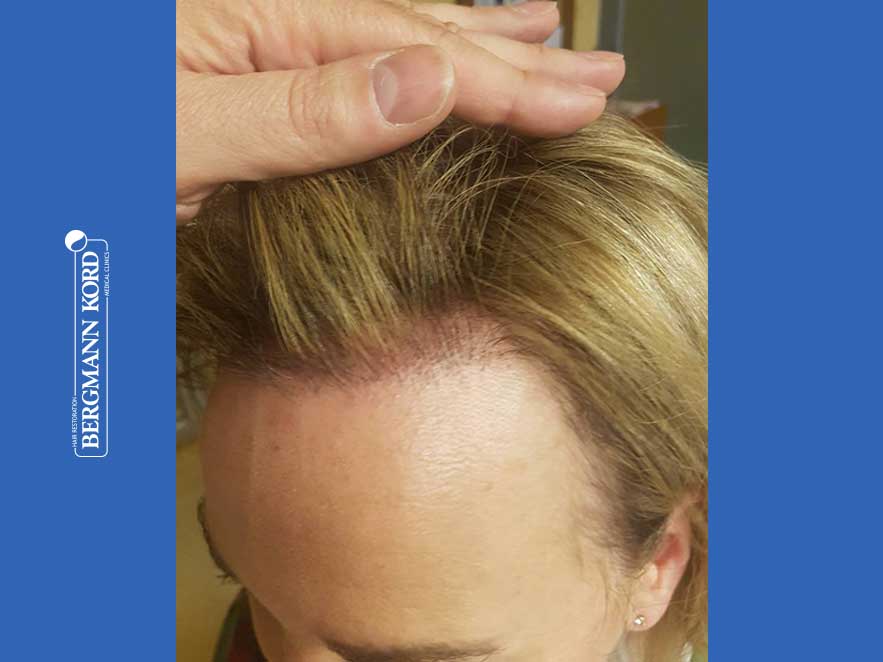 hair-transplantation-bergmann-kord-results-woman-66050PG-after-left-001