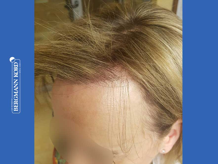 hair-transplantation-bergmann-kord-results-woman-66050PG-after-left2--001