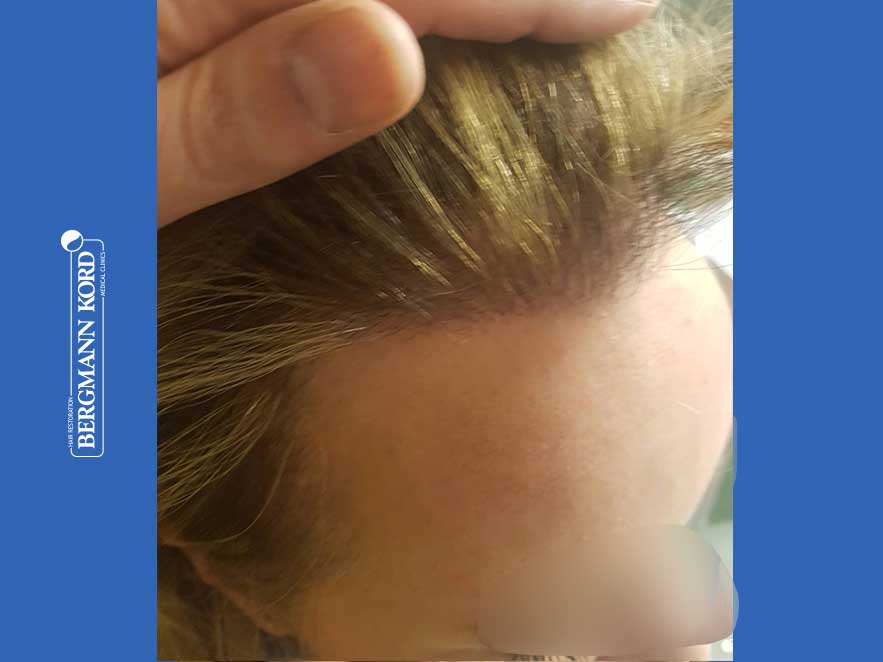 hair-transplantation-bergmann-kord-results-woman-66050PG-after-right-001