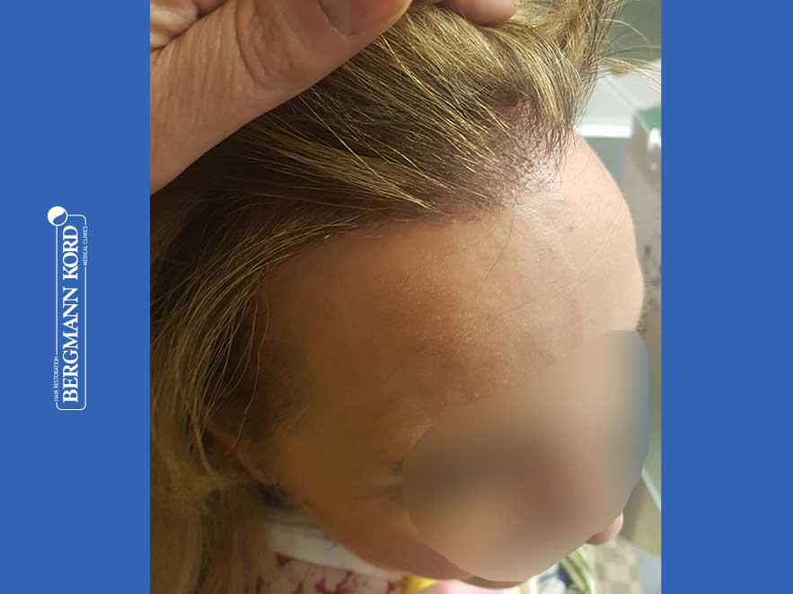hair-transplantation-bergmann-kord-results-woman-66050PG-after-right2-001