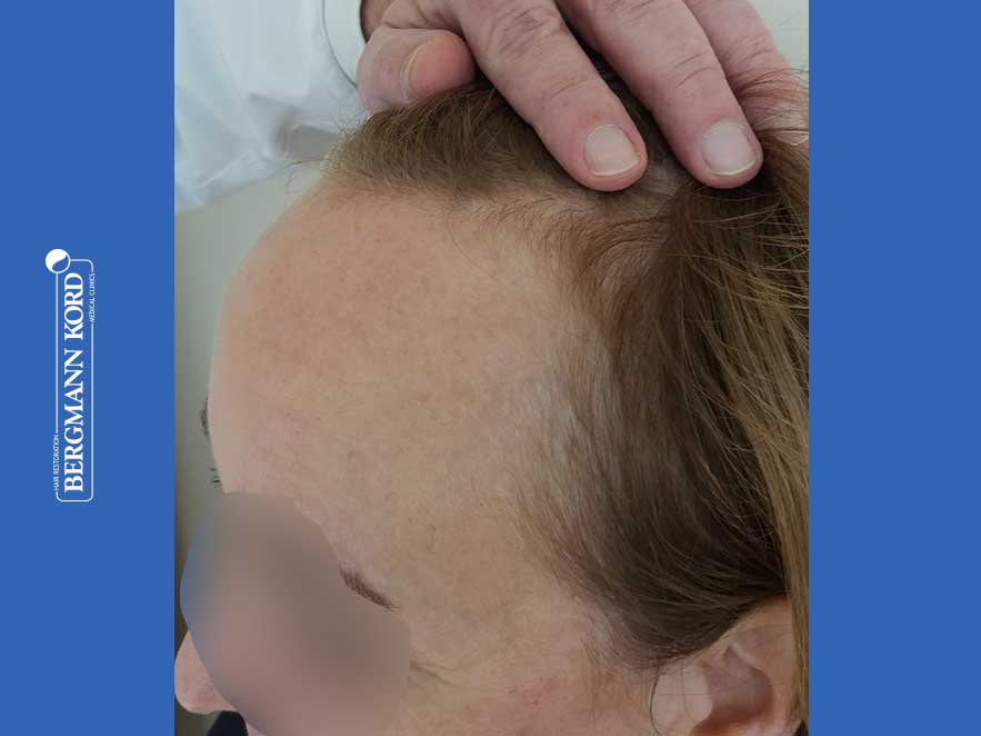 hair-transplantation-bergmann-kord-results-woman-66050PG-before-left-001