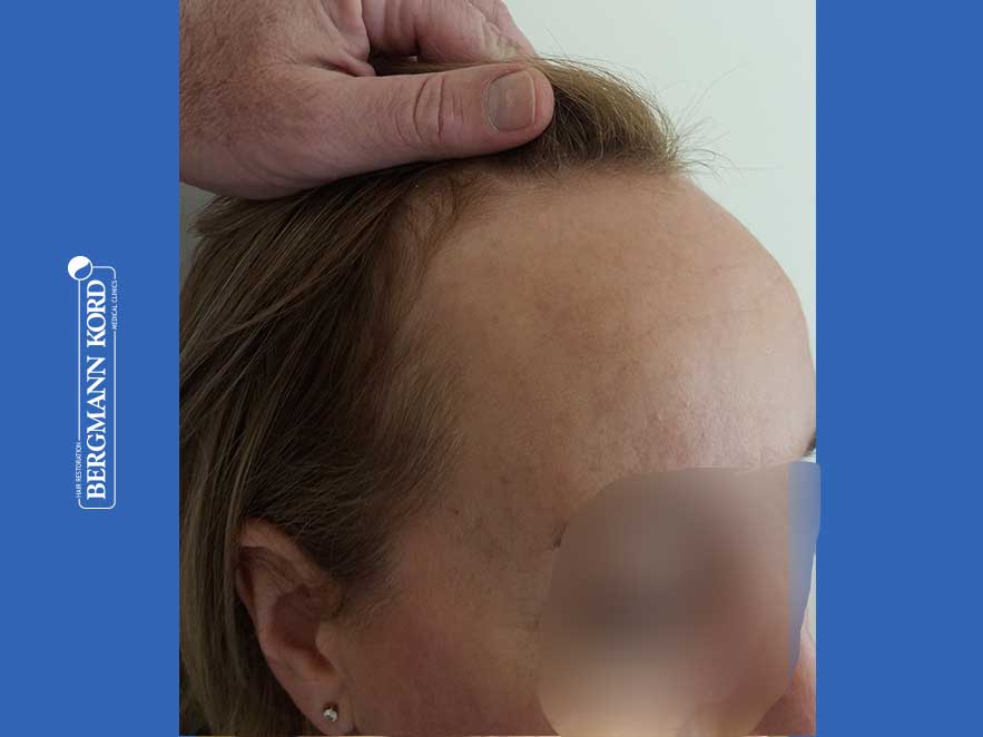 hair-transplantation-bergmann-kord-results-woman-66050PG-before-right-001