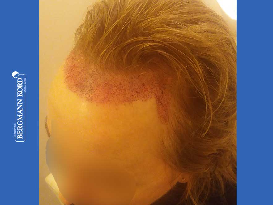 hair-transplantation-bergmann-kord-results-woman-66050PG-this-day-left-001