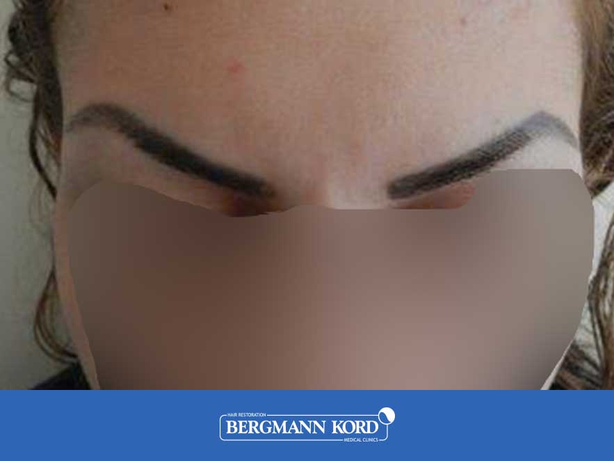 haarimplantation-bergmann-kord-ergebnisse-frau-45040PG-vor-front-001