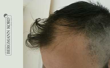 haartransplantation-bergmann-kord-ergebnisse-männer-43006PG-thumb-001
