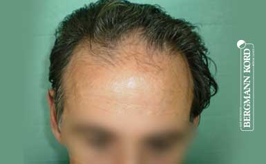 haartransplantation-bergmann-kord-ergebnisse-männer-50007PG-thumb-001