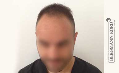 haartransplantation-bergmann-kord-ergebnisse-männer-51003PG-thumb-001