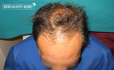 haartransplantation-bergmann-kord-ergebnisse-männer-56037PG-thumb-001