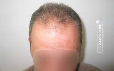 haartransplantation-bergmann-kord-ergebnisse-männer-62043PG-thumb-001