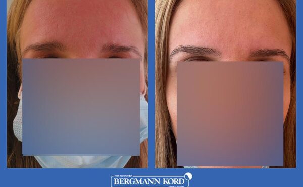 hair-implantation-bergmann-kord-results-woman-09638PG-before-after-001
