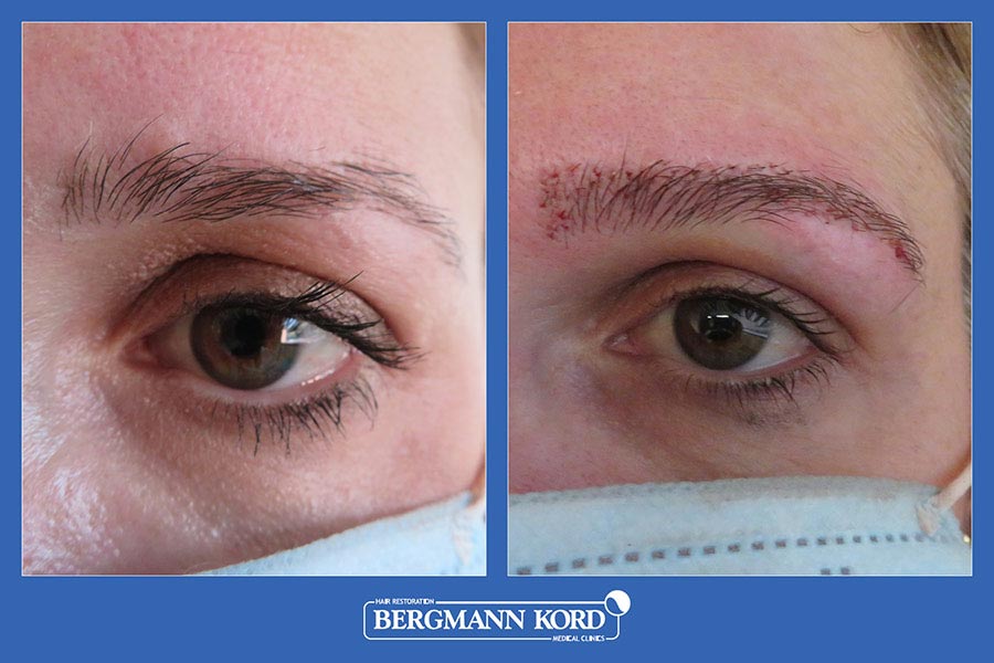 hair-implantation-bergmann-kord-results-woman-09638PG-before-after-005