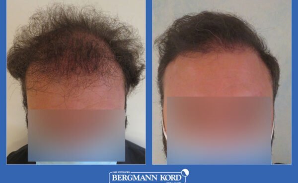 hair-transplantation-bergmann-kord-results-men-07542PG-before-after-001