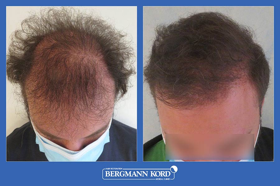 hair-transplantation-bergmann-kord-results-men-07542PG-before-after-002