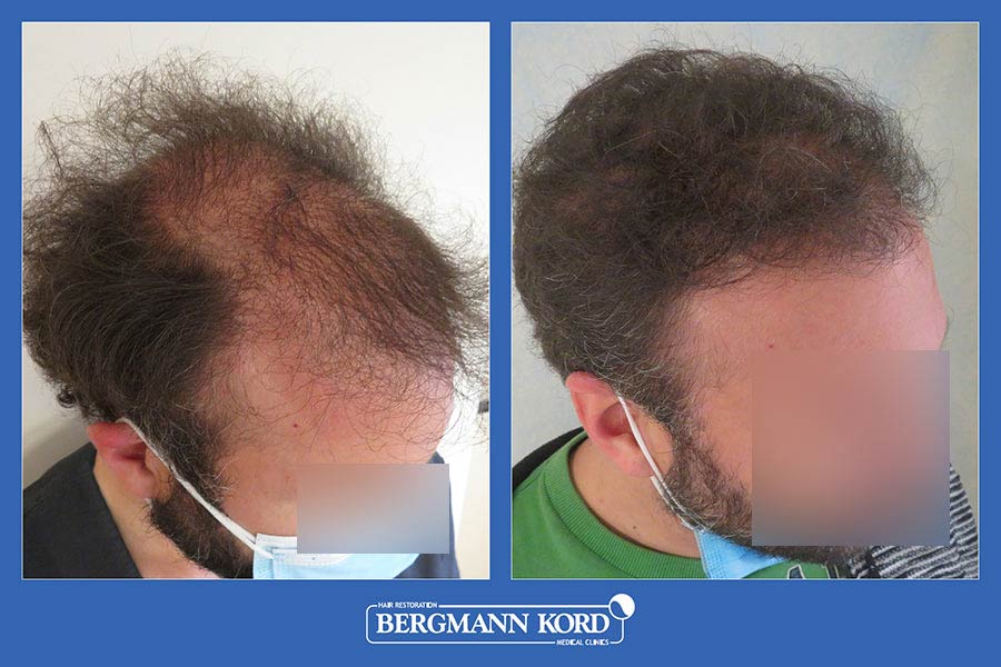 hair-transplantation-bergmann-kord-results-men-07542PG-before-after-004