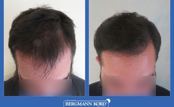 hair-transplantation-bergmann-kord-results-men-09345PG-before-after-001