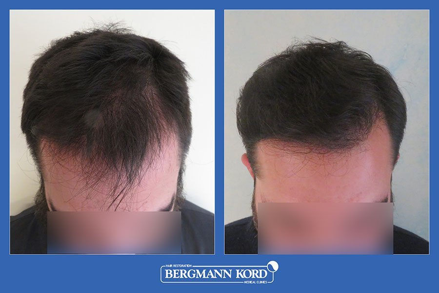 hair-transplantation-bergmann-kord-results-men-09345PG-before-after-001