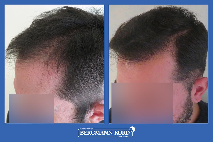 hair-transplantation-bergmann-kord-results-men-09345PG-before-after-003