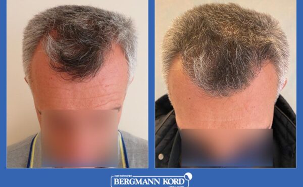 hair-transplantation-bergmann-kord-results-men-13567PG-before-after-001