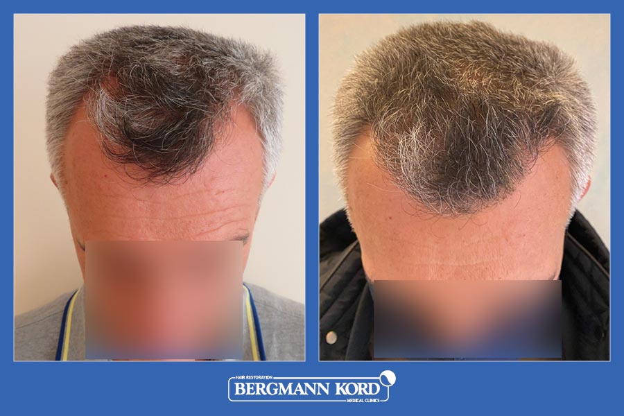 Hair Transplantation-Results-Men-13567PG-Bergmann Kord