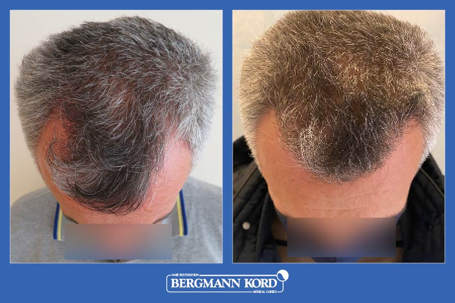 hair-transplantation-bergmann-kord-results-men-13567PG-before-after-004