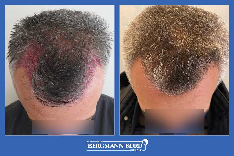 hair-transplantation-bergmann-kord-results-men-13567PG-before-after-005
