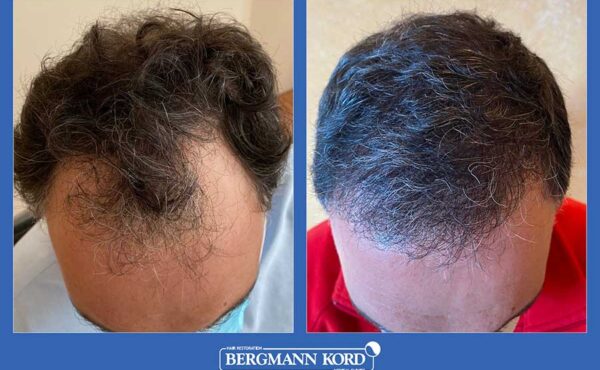 hair-transplantation-bergmann-kord-results-men-37778PG-before-after-001