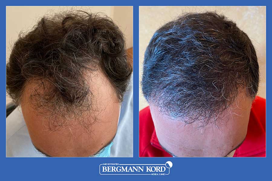 hair-transplantation-bergmann-kord-results-men-37778PG-before-after-001
