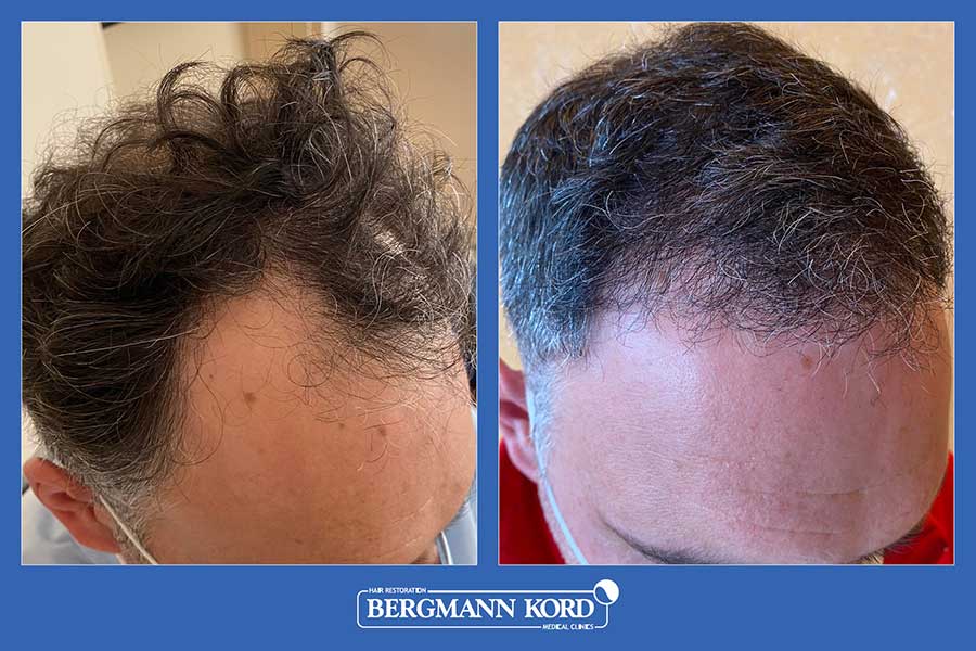 hair-transplantation-bergmann-kord-results-men-37778PG-before-after-002