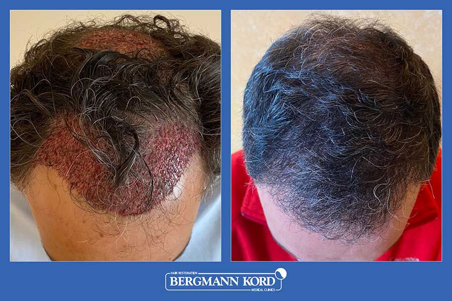 hair-transplantation-bergmann-kord-results-men-37778PG-before-after-004