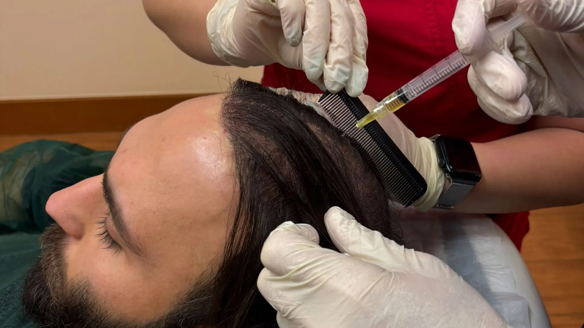 Αυτόλογη μεσοθεραπεία μαλλιών για την κατάπολεμηση της τριχόπτωσης
