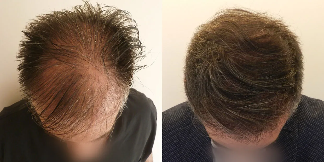 Αποτέλεσμα μεταμόσχευσης μαλλιών