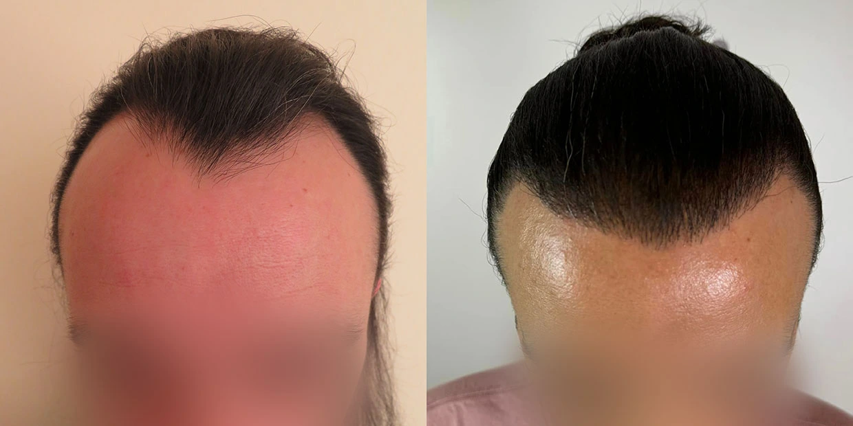 Αποτέλεσμα μεταμόσχευσης μαλλιών