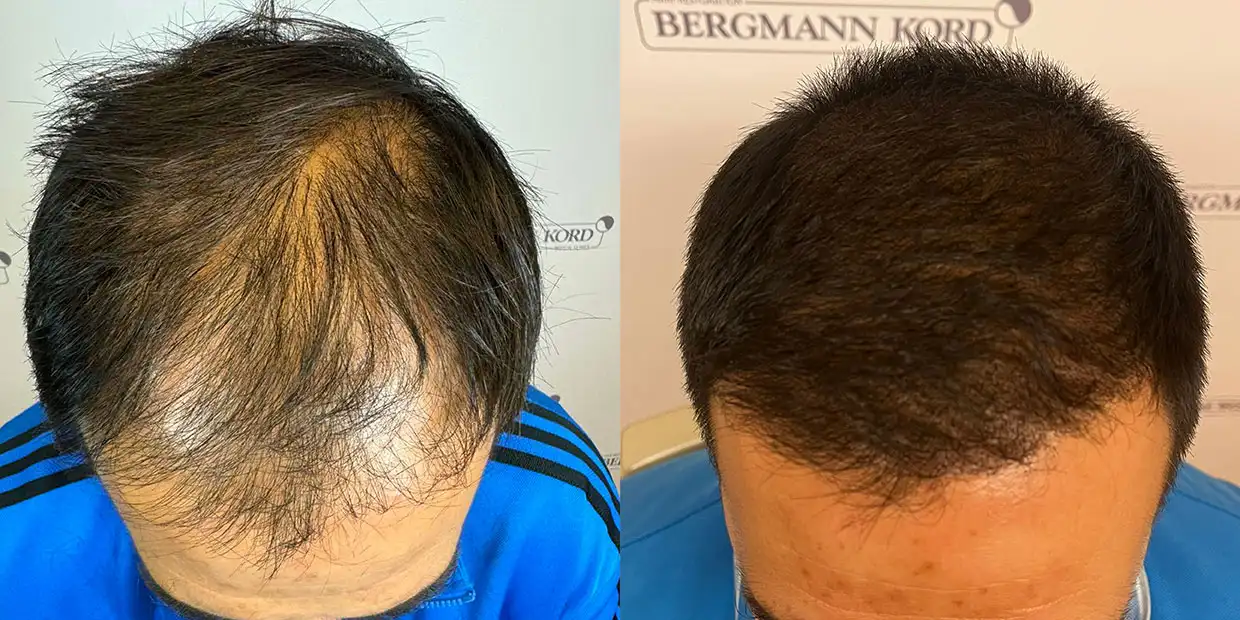 Αποτέλεσμα μεταμόσχευσης μαλλιών