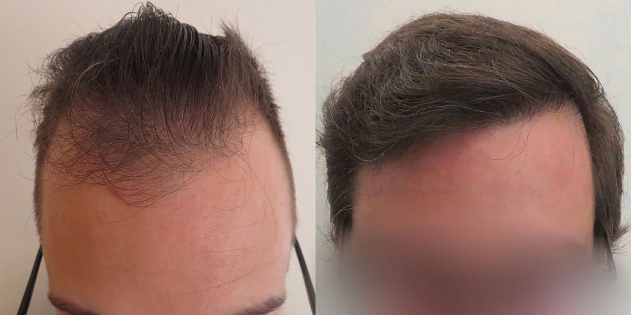 Αποτέλεσμα μεταμόσχευσης μαλλιών