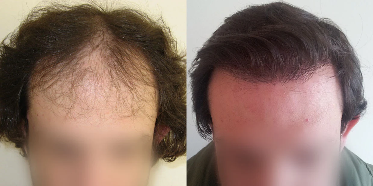 Αποτέλεσμα μεταμόσχευσης μαλλιών