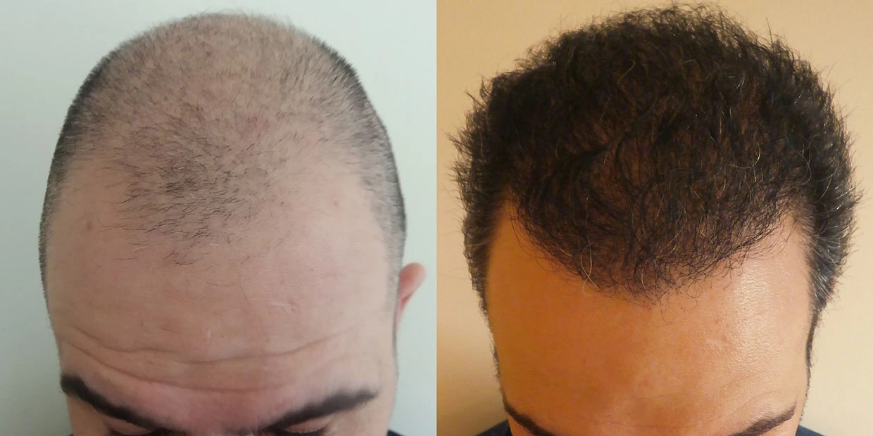 Αποτέλεσμα μεταμόσχευσης μαλλιών