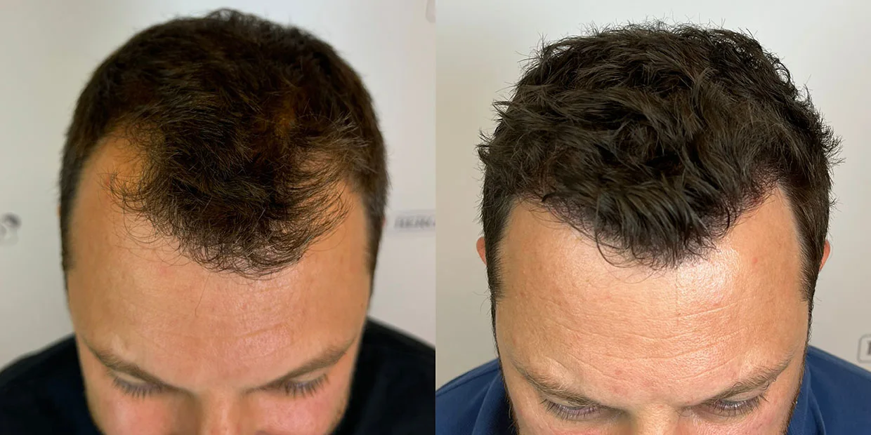 Αποτέλεσμα μεταμόσχευσης μαλλιών