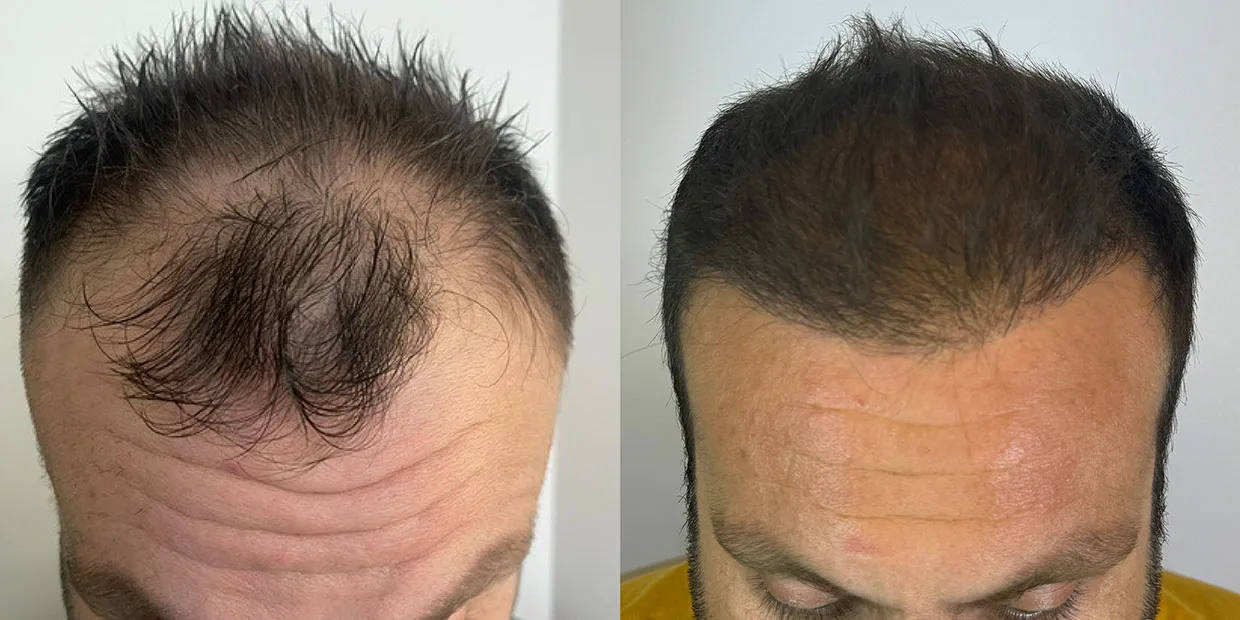 Αποτέλεσμα μεταμόσχευσης μαλλιών